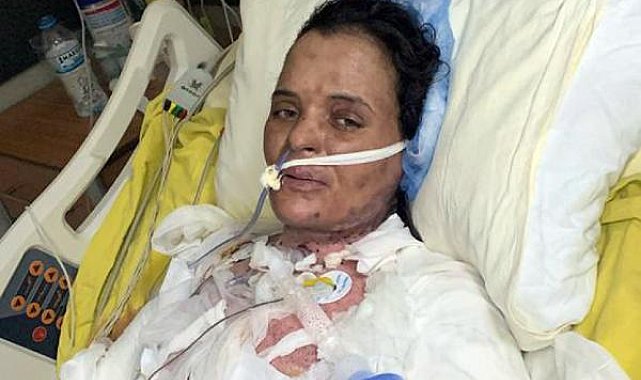 Dezenfektanın parlamasıyla yanan Havva, 75 gündür yoğun bakımda