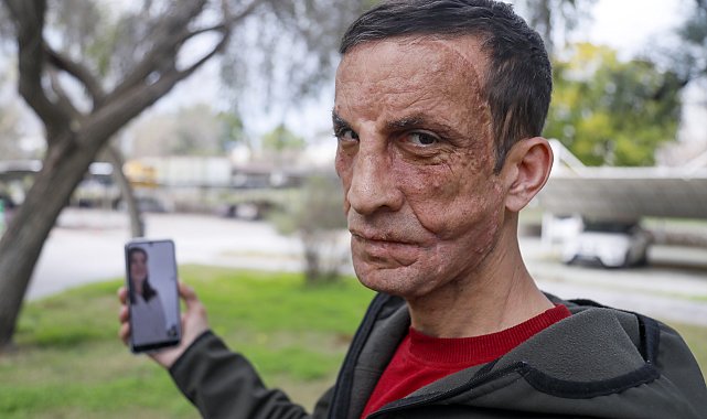 Babasının yüzünün nakledildiği Uğur'la duygulandıran görüşme